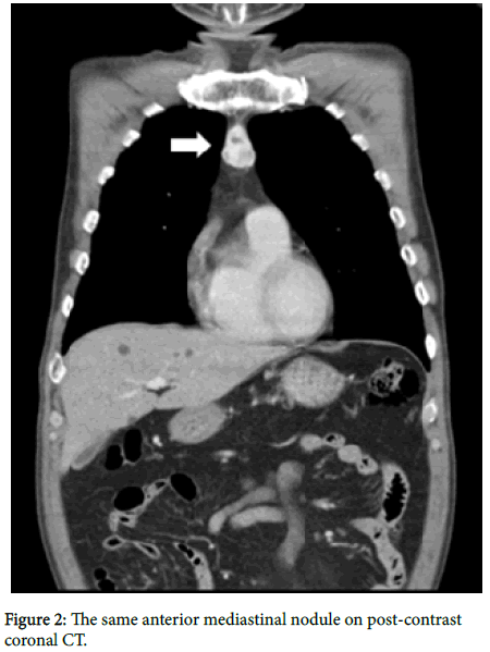 clinical-images-case-reports-mediastinal-nodule
