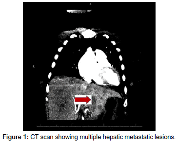 clinical-images-case-reports-multiple-hepatic
