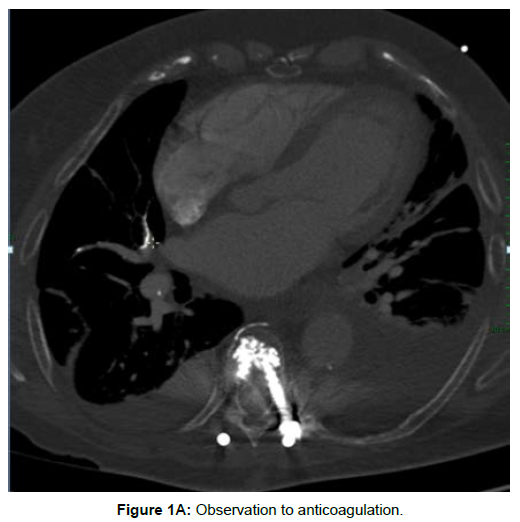 clinical-images-case-reports-observation-anticoagulation