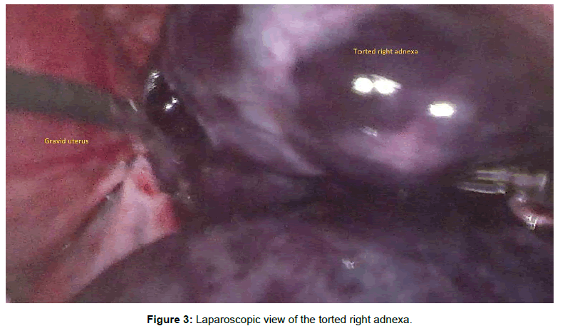 clinical-images-case-reports-torted-adnexa