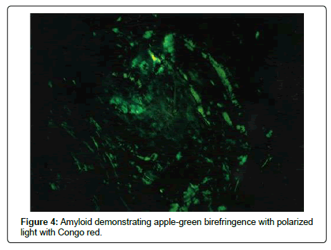 clinical-oncology-Amyloid-demonstrating
