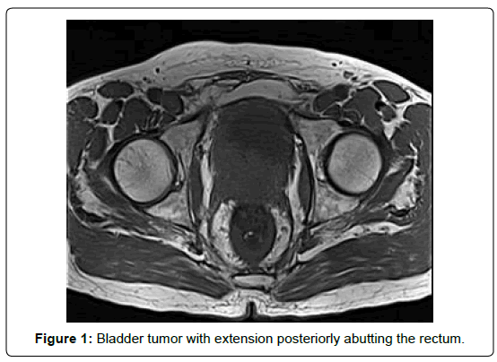 clinical-oncology-Bladder-tumor