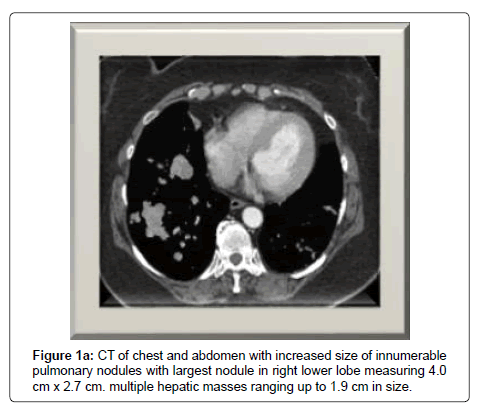 clinical-oncology-CT-chest