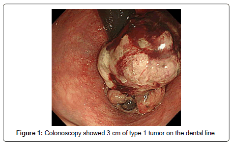 clinical-oncology-Colonoscopy
