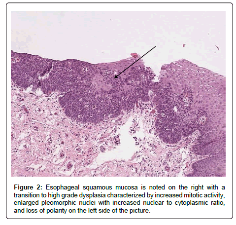 clinical-oncology-Esophageal-squamous