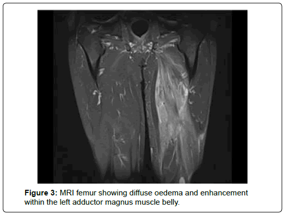 clinical-oncology-MRI-femur