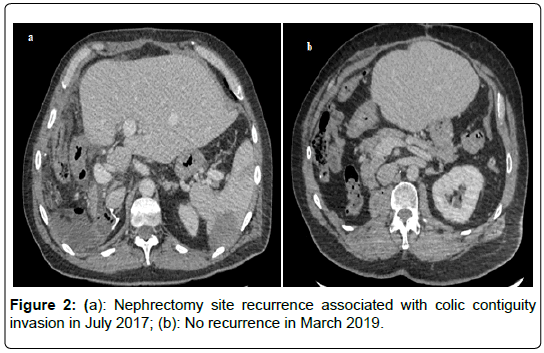 clinical-oncology-Nephrectomy-site