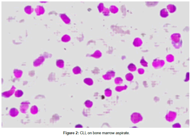 clinical-oncology-bone-marrow