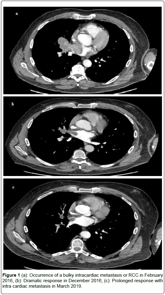 clinical-oncology-cardiac-metastasis