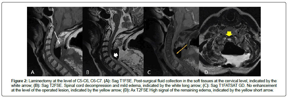 clinical-oncology-case-Laminectomy