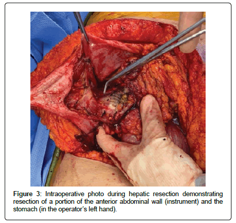 clinical-oncology-case-hepatic