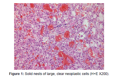 clinical-oncology-case-reports-clear-neoplastic