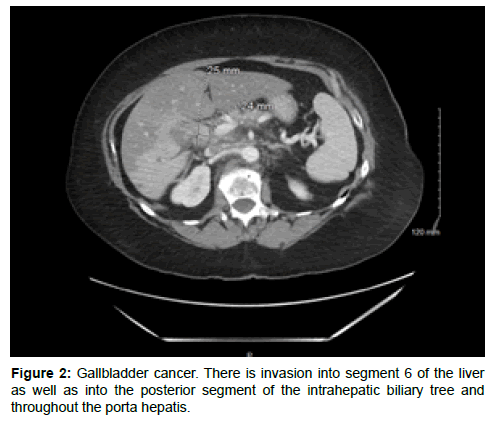 clinical-oncology-case-reports-intrahepatic-biliary