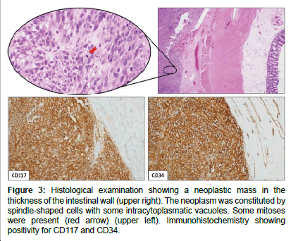 clinical-oncology-case-reports-neoplastic-mass