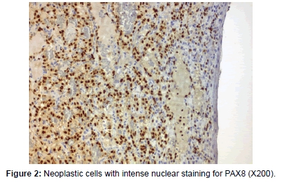 clinical-oncology-case-reports-nuclear-staining