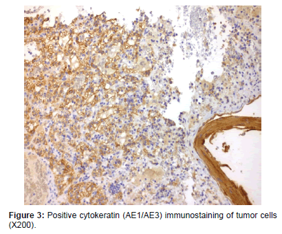 clinical-oncology-case-reports-tumor-cells