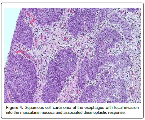 clinical-oncology-desmoplastic-response