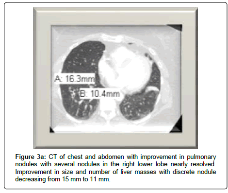 clinical-oncology-discrete-nodule