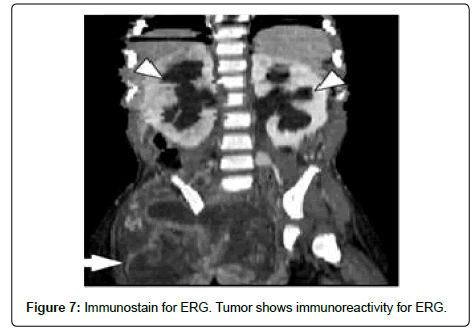clinical-oncology-immunoreactivity