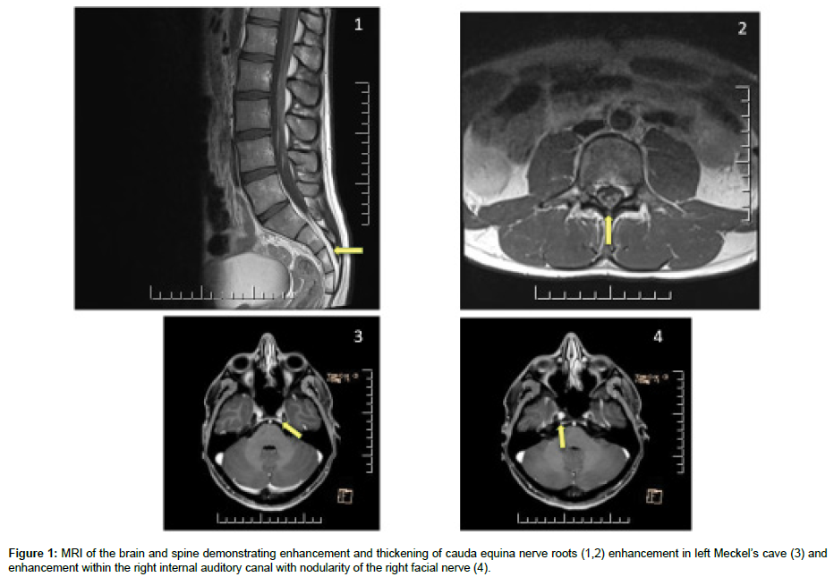 clinical-oncology-nerve-roots