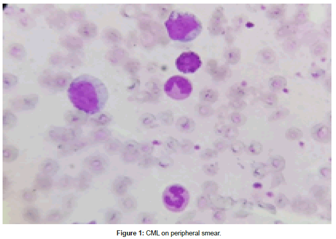 clinical-oncology-peripheral-smear