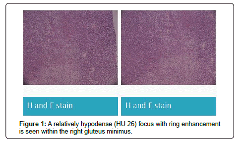 clinical-oncology-relatively-hypodense