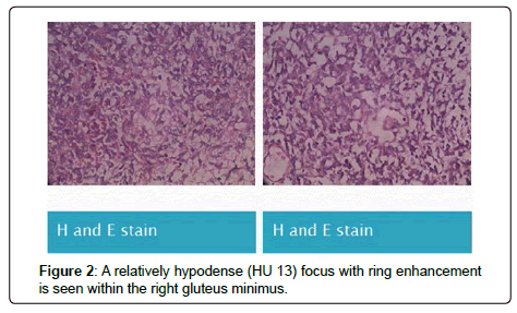 clinical-oncology-ring-enhancement