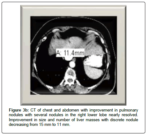 clinical-oncology-several-nodules