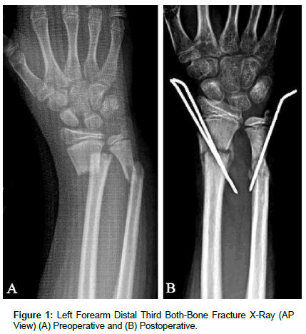 clinical-research-orthopedics-Left-Forearm