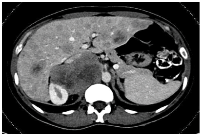 cocr-metastases cocr-metastases