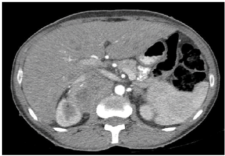 cocr-adrenal cocr-adrenal