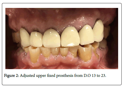 dental-health-Adjusted-upper