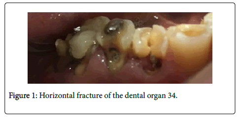 dental-health-Horizontal-fracture