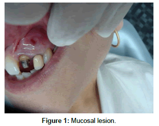 dental-health-Mucosal-lesion