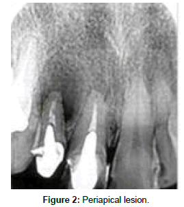 dental-health-Periapical-lesion