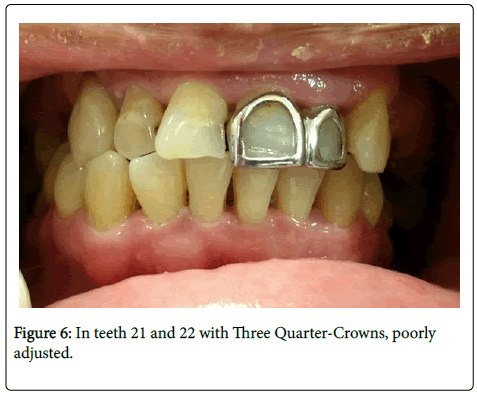 dental-health-Quarter-Crowns