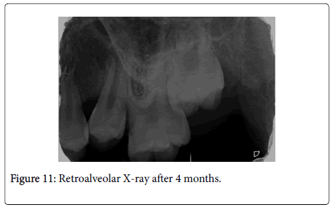dental-health-Retroalveolar
