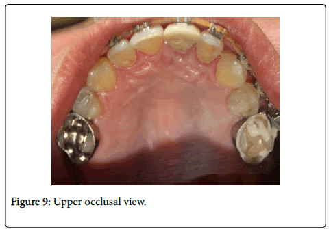 dental-health-Upper-occlusal