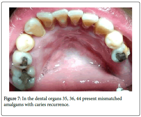 dental-health-caries-recurrence