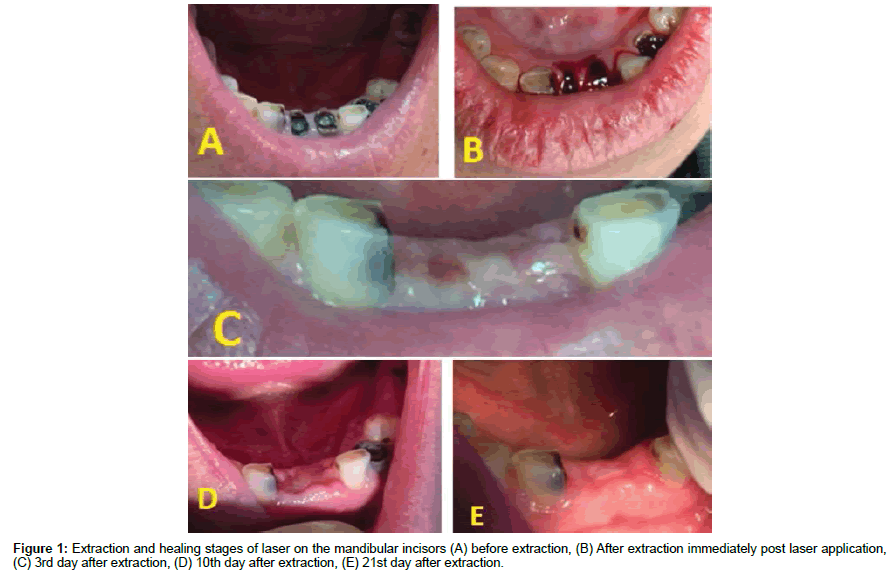 dental-health-healing-stages