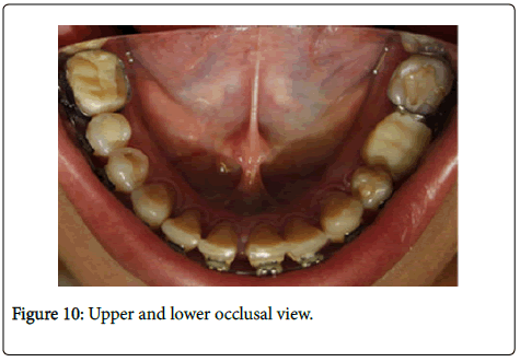 dental-health-lower-occlusal