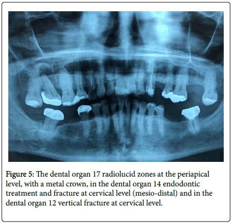 dental-health-mesio-distal