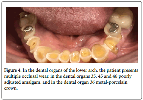 dental-health-occlusal-wear