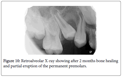 dental-health-partial-eruption