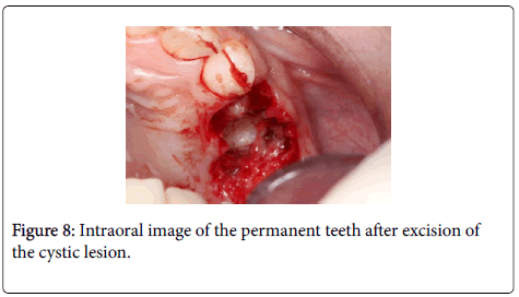 dental-health-permanent-teeth