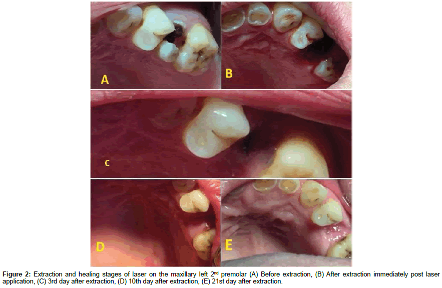 dental-health-post-laser