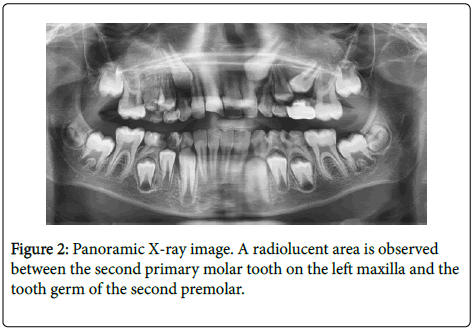dental-health-radiolucent-area