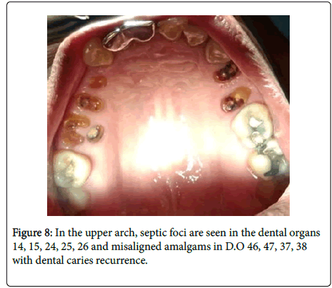 dental-health-septic-foci