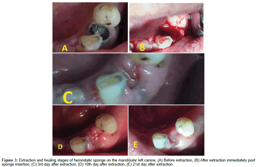 dental-health-sponge-insertion