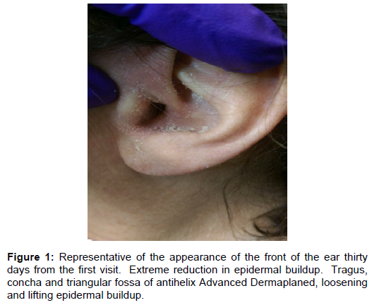 dermatology-research-epidermal-buildup